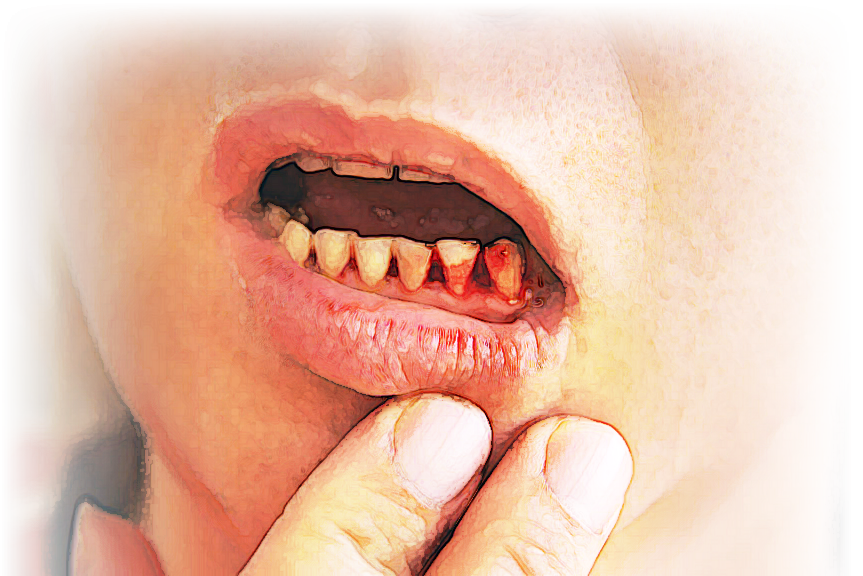 Teeth Falling Out With Blood
